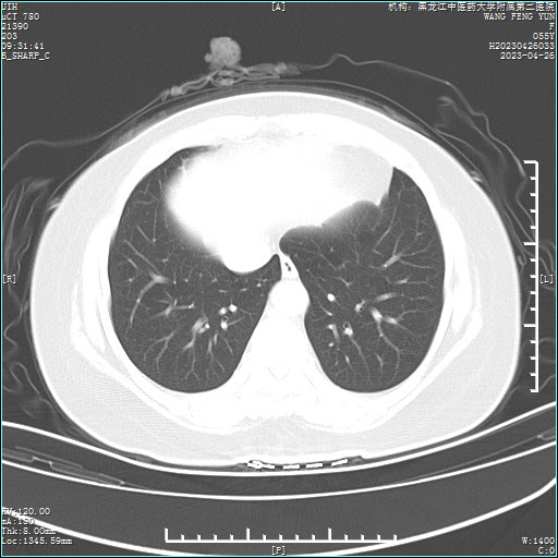 肺炎CT