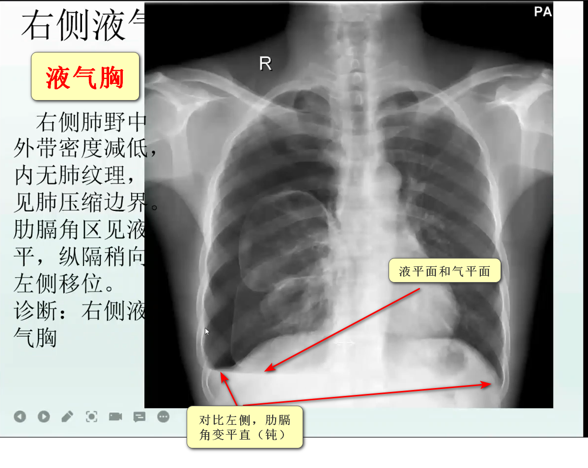 气胸和液气胸