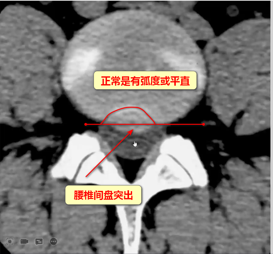 腰椎间盘突出